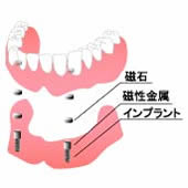 磁性アタッチメントとインプラントを用いた総義歯